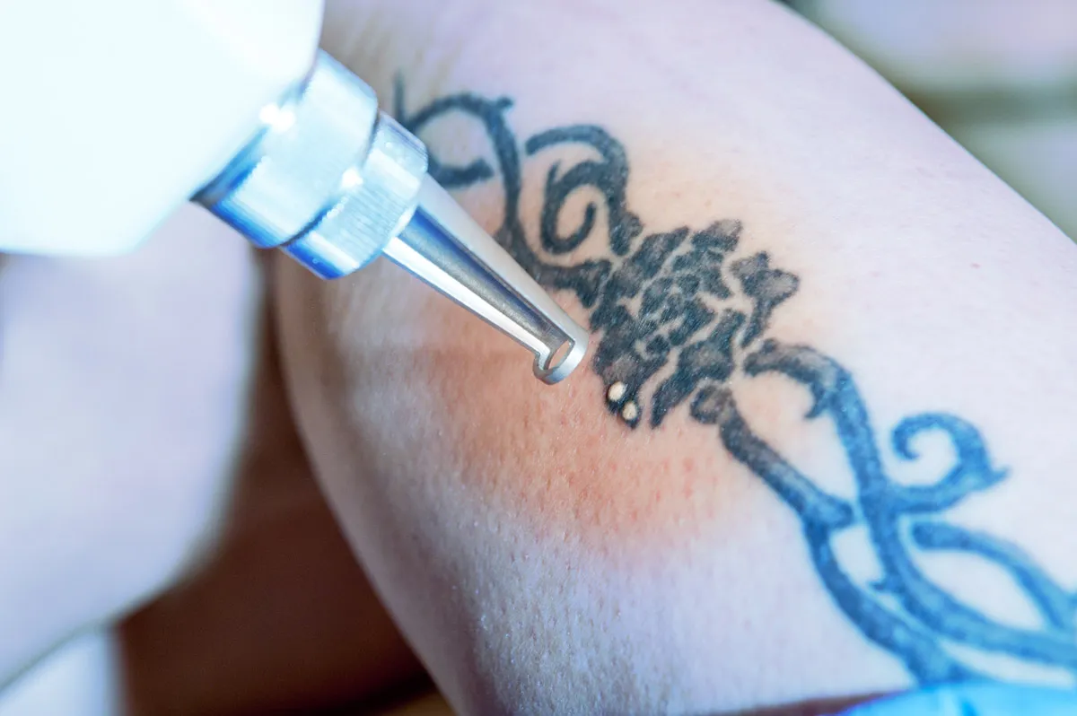 Nahaufnahme Tattoo Entfernung per Laser