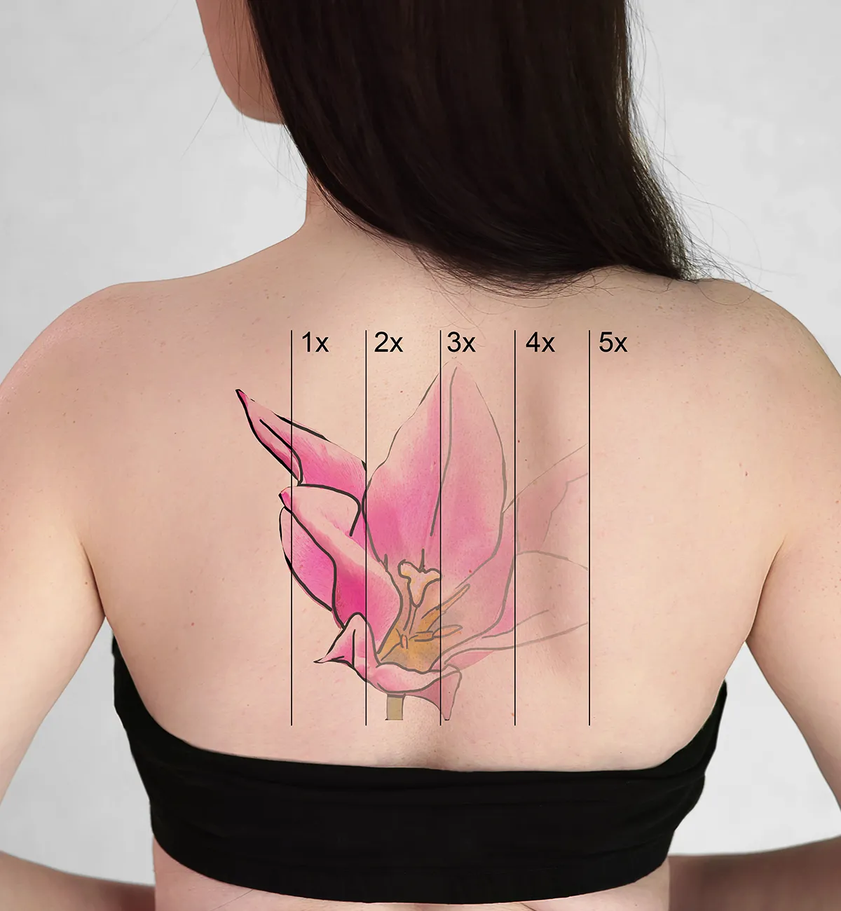 Großes Blütentattoo auf dem Rücken einer weiblichen Person mit den Darstellungen nach 5 Tattooentfernungssitzungen